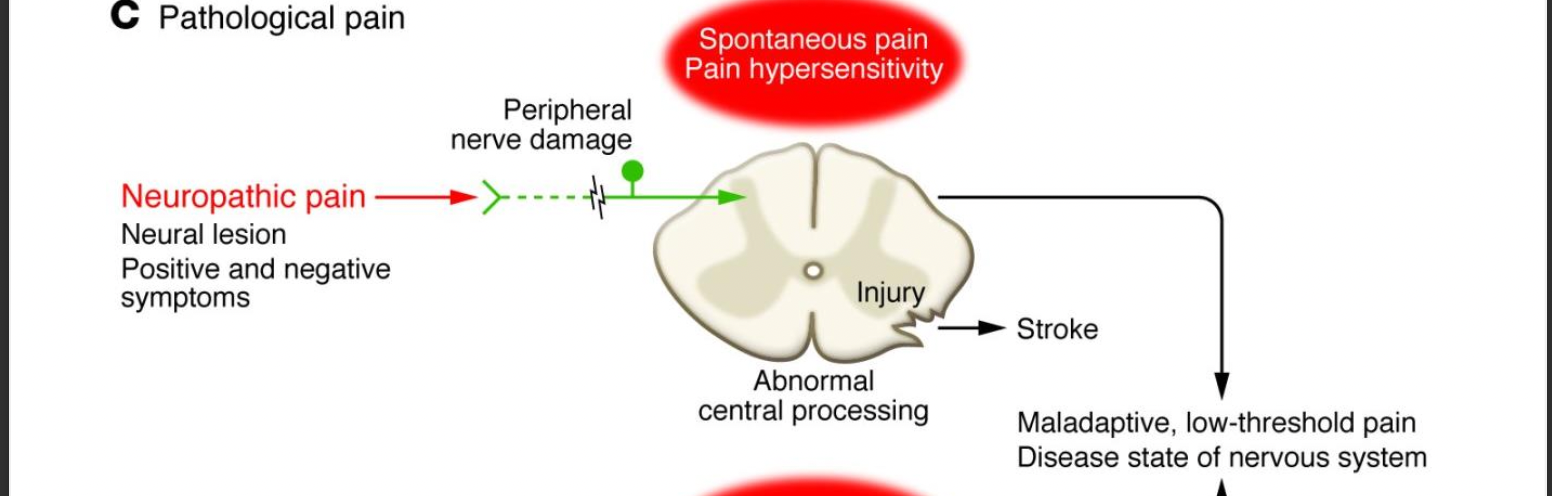 <p>neural lesion, positive and negative symptoms -&gt; peripheral nerve damage -&gt; abnormal central spinal processing -&gt; stroke OR -&gt; maladaptive , low-threshold pain disease state of nervous system</p>