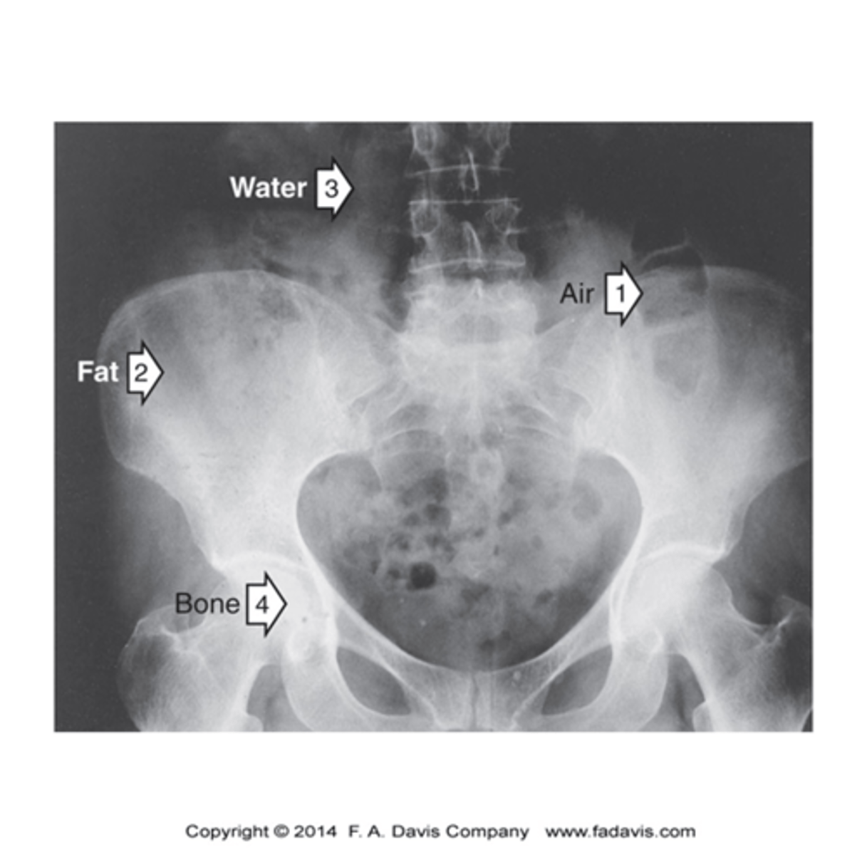 <p>Inverse Relationship</p><p>- Radiopaque = Bone</p><p>- Radiolucent = Air</p>