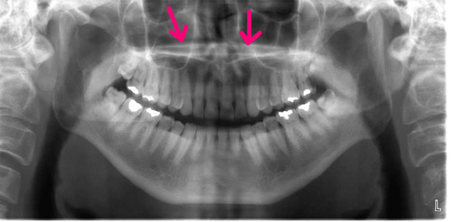 <p>Idenifty the structure.</p><p>a. hard palate</p><p>b. soft palate</p><p>c. epiglottis</p><p>d. uvula</p>