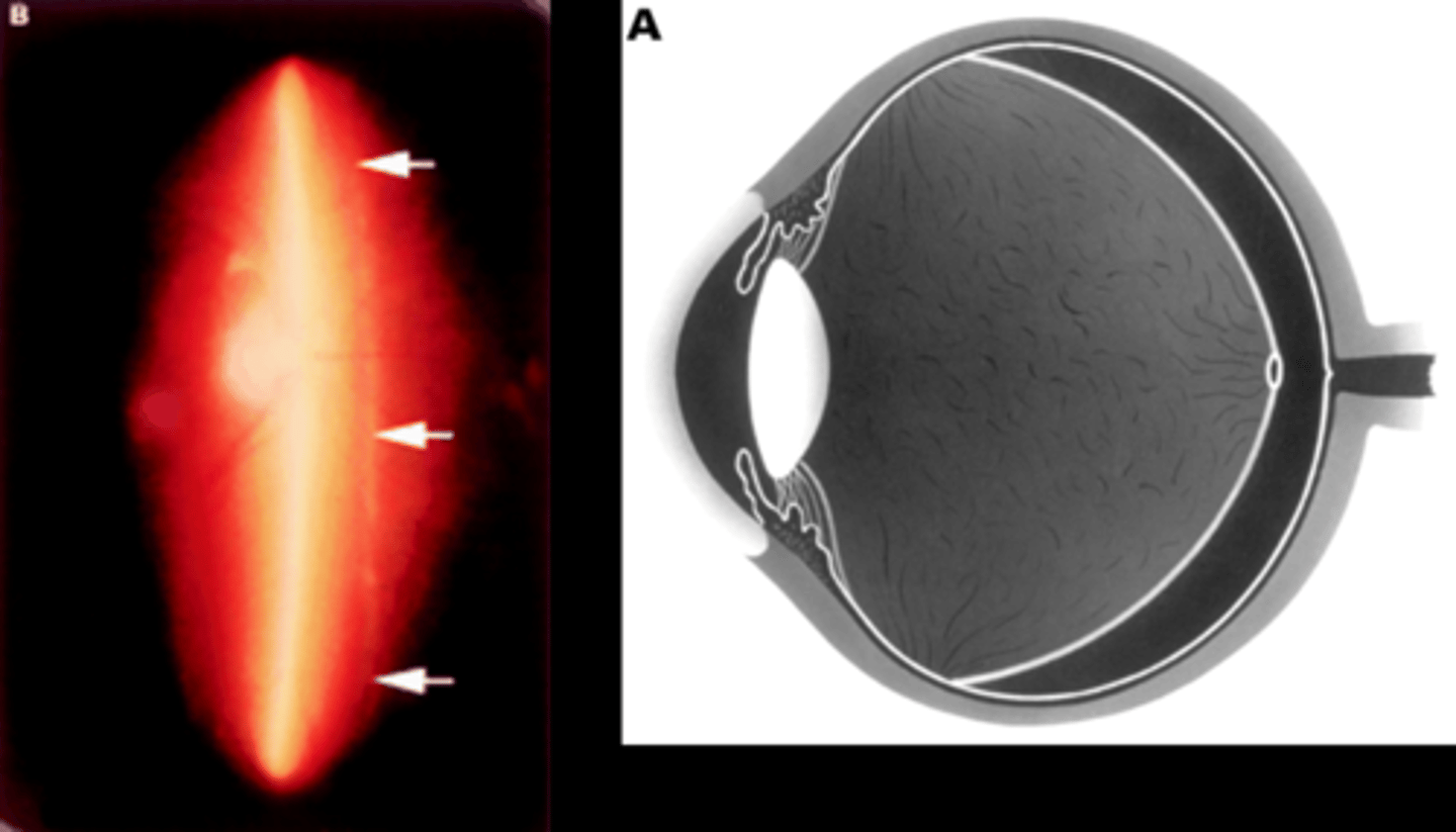 <p>posterior hyaloid face separate from retina = with optic section beam, go slightly off axis or off click-stop, and focus in front of the retina</p>
