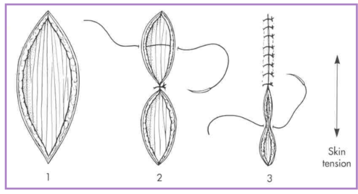 <ul><li><p>place suture across widest part of defect (center) </p></li><li><p>divide each remaining segment in half with subsequent sutures </p></li></ul><p></p>