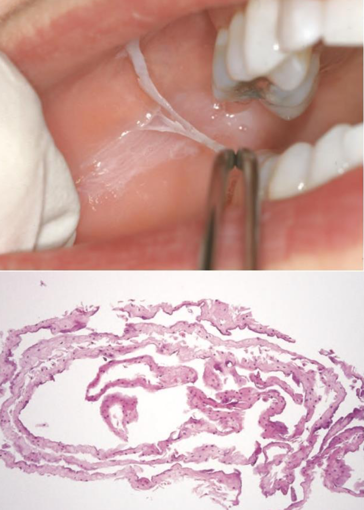 <p>which environmental/reactive lesion:</p><ul><li><p>Painless, thready white tissue on the mucosa, peels off leaving normal mucosa</p></li><li><p>Caustic mouth washes high in alcohol content</p></li><li><p>Strong toothpastes (whitening)</p></li><li><p>Other contactants that are irritants the mucosa </p></li><li><p>Discontinuation of offending agent</p></li></ul><p></p>