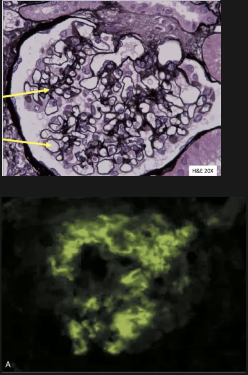 <p>Nefritis mesangial mínima lúpica de clase 1</p><ul><li><p>Estrucutra histológica normal fel glomérulo&nbsp;</p></li><li><p>En microscopía electrónica e inmunofluorescencia hay depósitos<strong> mínimos</strong>&nbsp;de inmunocomplejos en el mesangio</p></li></ul><p></p><p>Presentación clínica:</p><ul><li><p>Función renal normal</p></li><li><p>Rara vez hay síndrome nefrótico</p></li></ul><p></p>
