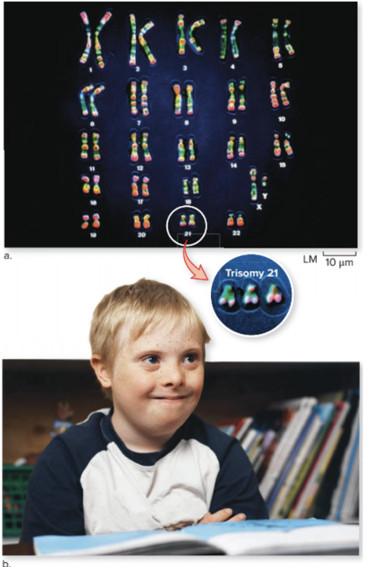 <p>Down syndrome </p>