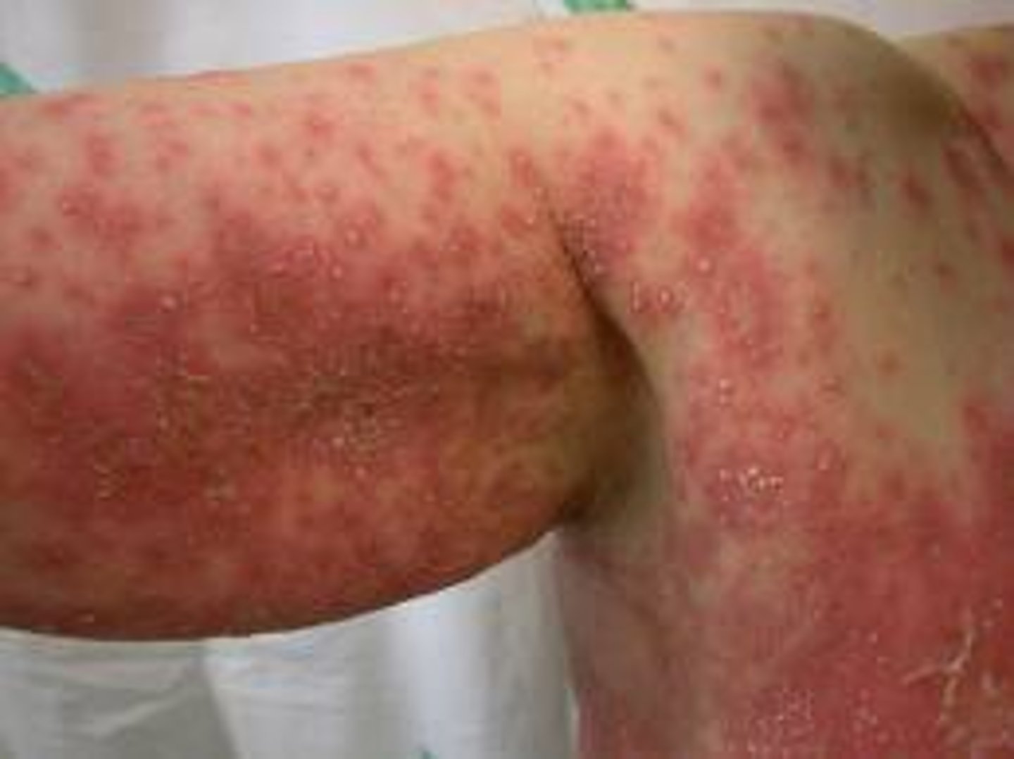 <p>type IVd disease</p>