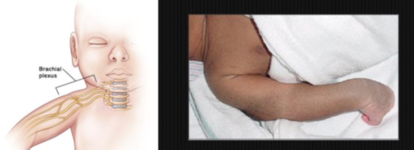 <p>spinal birth injury = most common</p><p>neuroblastoma</p><p>mediastinal mass</p><p>benign neck mass</p><p>infectious mass</p>