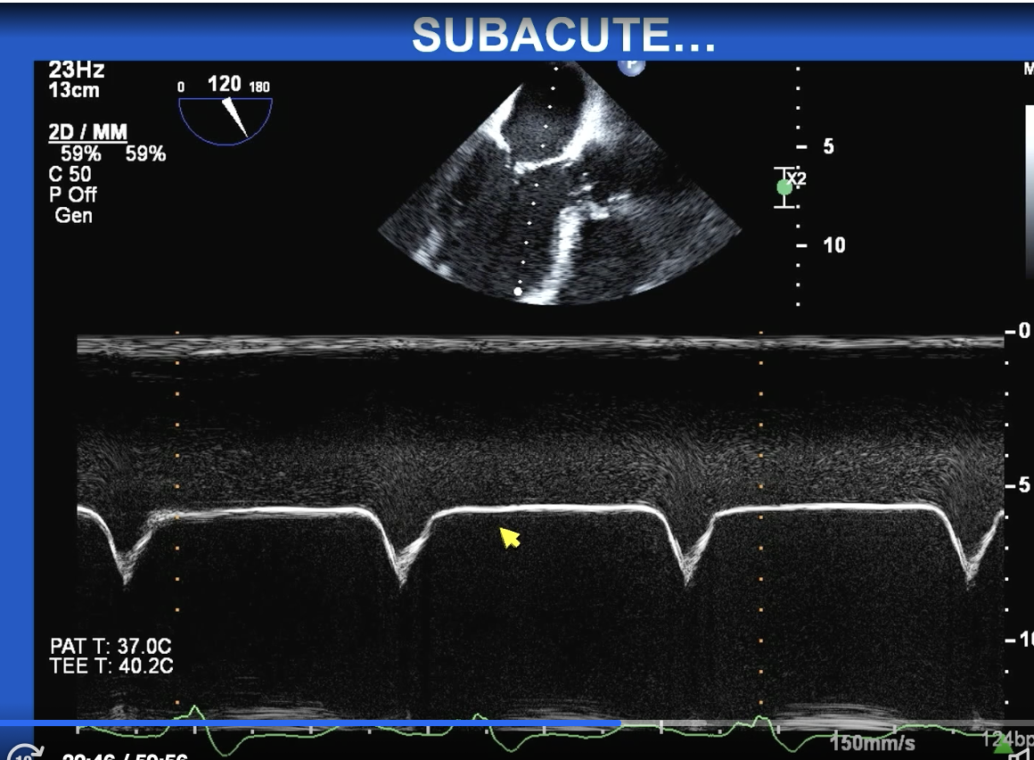 <p>Subacute AR</p><p>— First picture arrow is showing early closure of the mitral valve and after it shows some end diastolic MR</p><p>— M Mode of mitral valve shows this “M” sign type thing but basically the AR is so bad that it shuts the mitral valve for so long because the pressure in the LV is so overwhelming. </p>