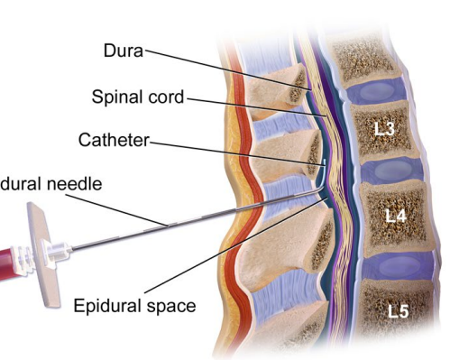 <p><strong>Epidural</strong></p><p>-Epidural catheter is placed in ___-_ interspace</p><p>-Provides continuous infusion of medication, which is a local anesthetic plus ______</p><p>-Does not remove all __________ completely </p><p>-Side effects → ___________, fetal bradycardia, fever, ____ soreness, headache, maternal respiratory ____________ if level too high, hematoma </p>