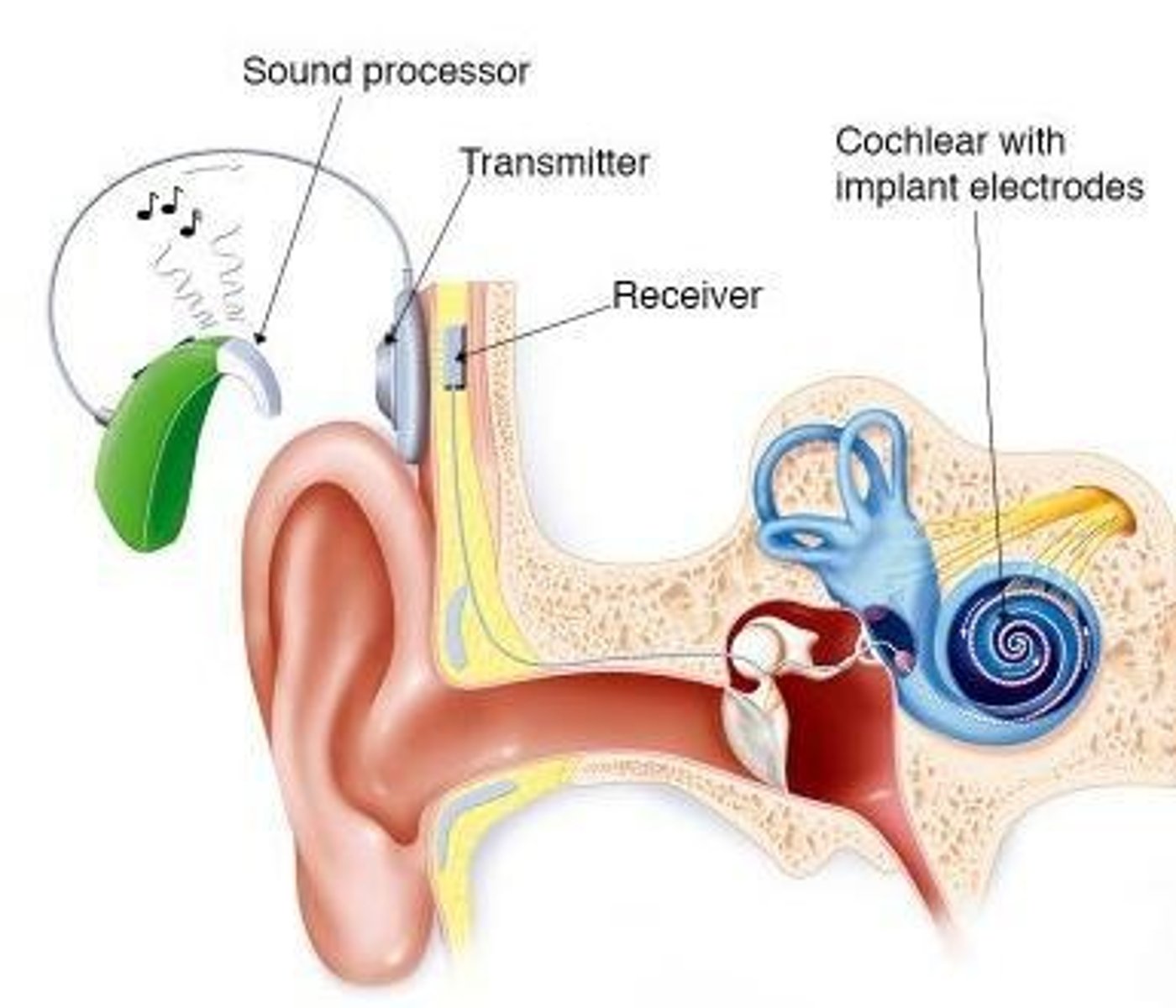 <p>To create a new hearing pathway by bypassing damaged hair cells and stimulating the auditory nerve directly.</p>