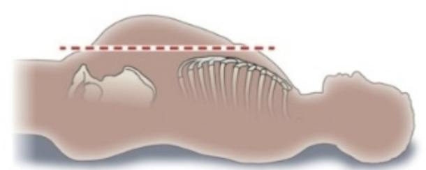 <p>Abdomen is bulging or swollen outward, often indicating underlying issues such as obesity or fluid accumulation</p>