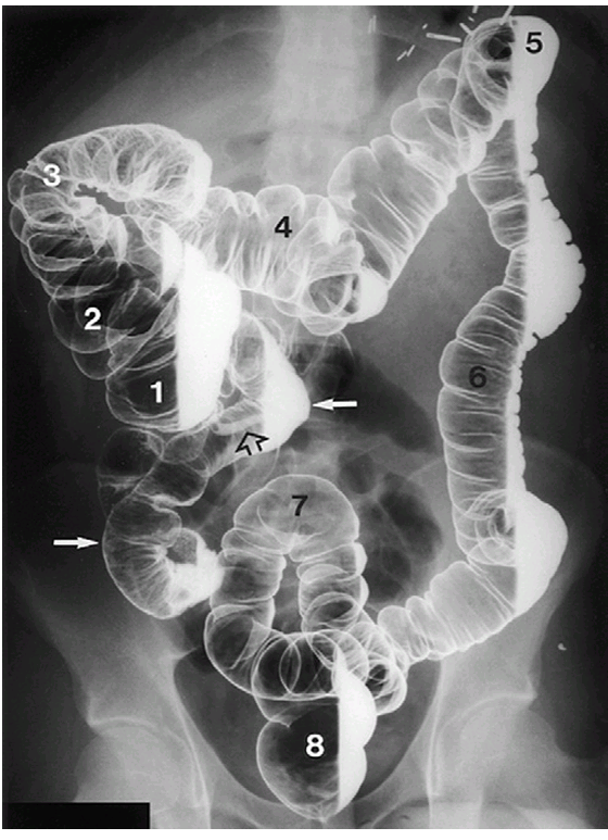 <p>—  are used to visualize the large intestine. The double-contrast technique uses a combination of barium and air to visualize the large intestine and is considered a more precise procedure</p>