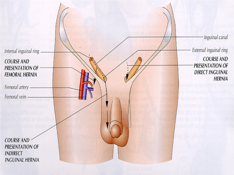 <p>What structure?</p><ul><li><p>lies below inguinal ligament </p></li><li><p>locate by placing R index finger from below on R femoral artery &amp; middle finger will overlie femoral vein &amp; ring finger will be on femoral canal where herniation may occur</p></li></ul><p></p>