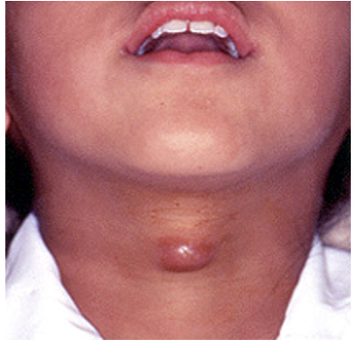 <p>What is the treatment for a thyroglossal duct cyst?</p>