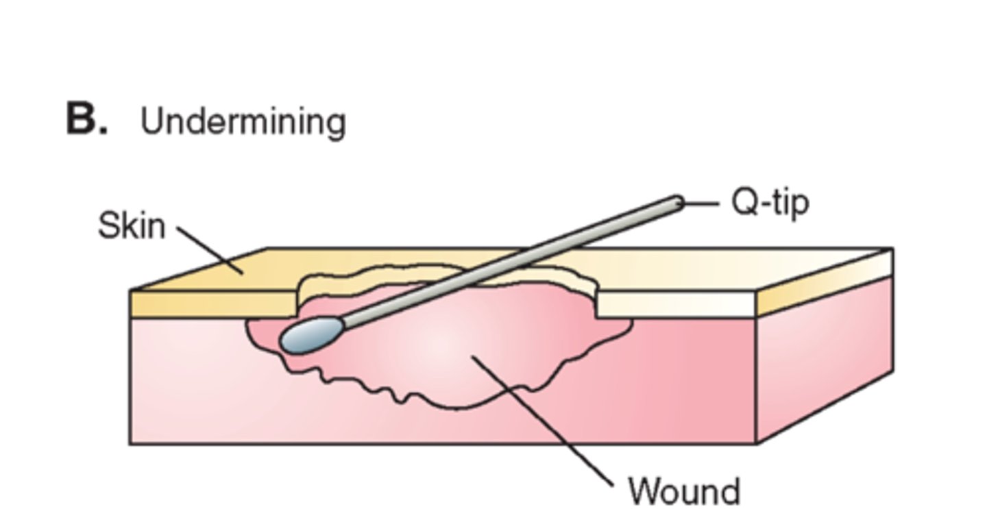 <p>erosion of tissue from underneath intact skin at wound edge</p><p>*insert sterile cotton-tipped applicator for depth</p><p>**measure in cm at o'clock positioning</p>