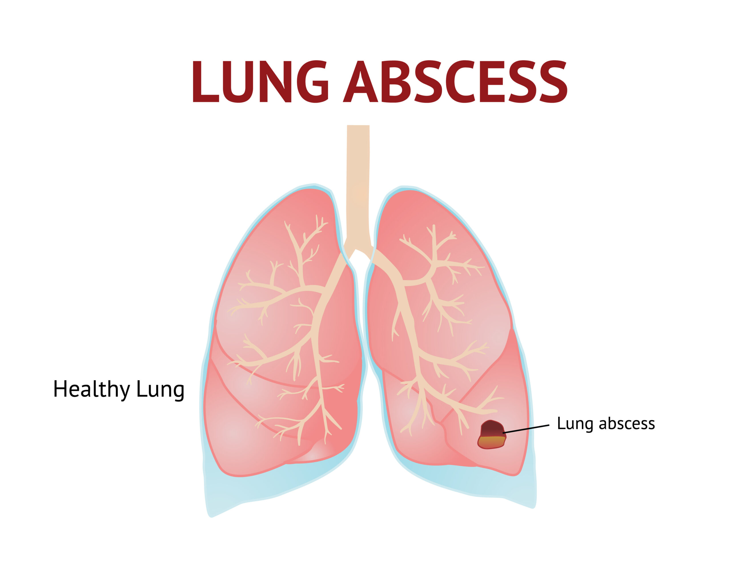<p>abscess formation (lung abscess) </p>