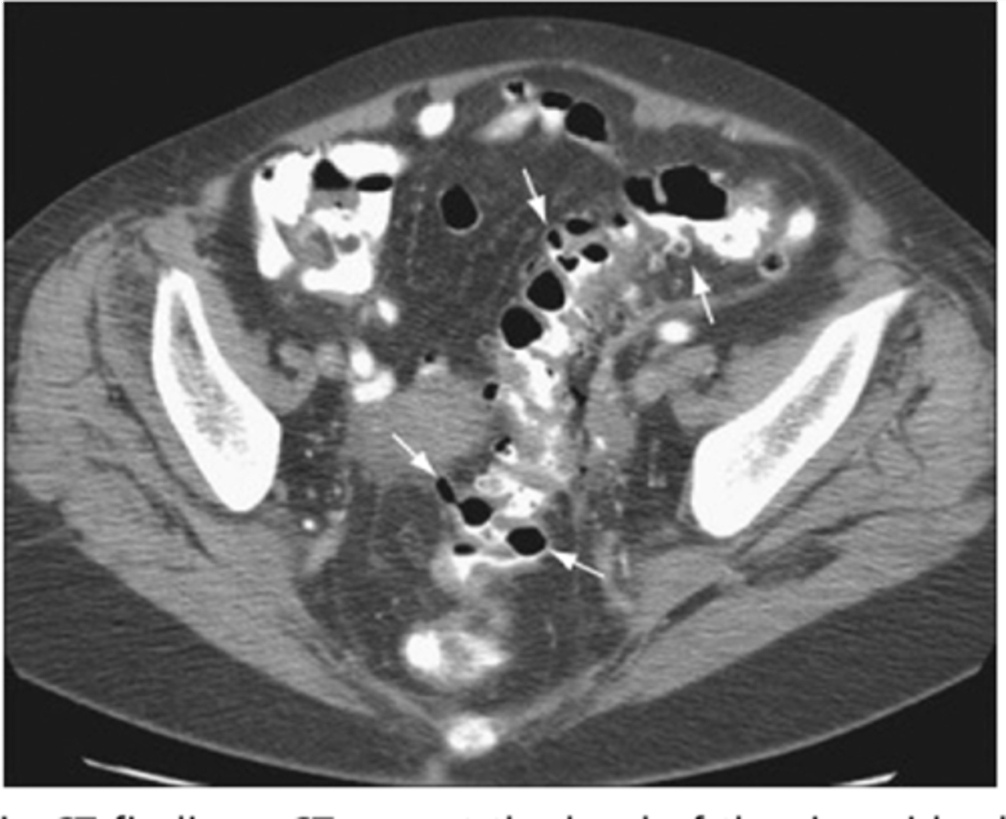 <p>air filled outpouchings of colon that represent diverticula</p>