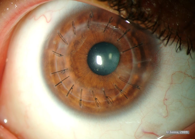 penetrating keratoplasty - full thickness corneal transplant