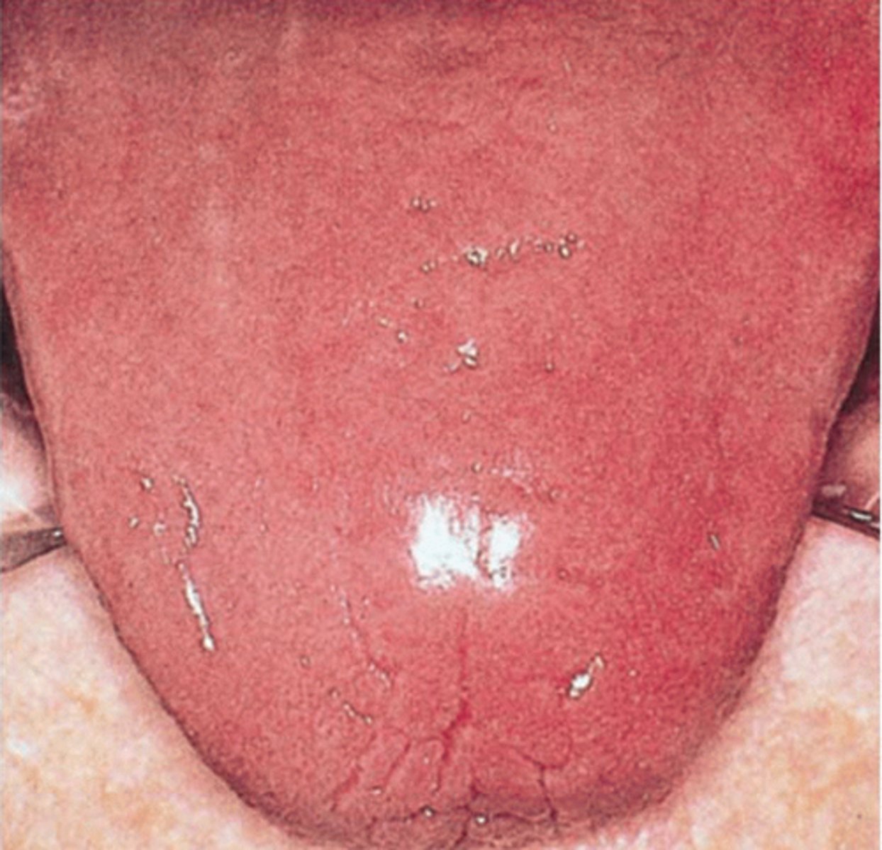 <p>loss of tongue papilla, smooth</p>