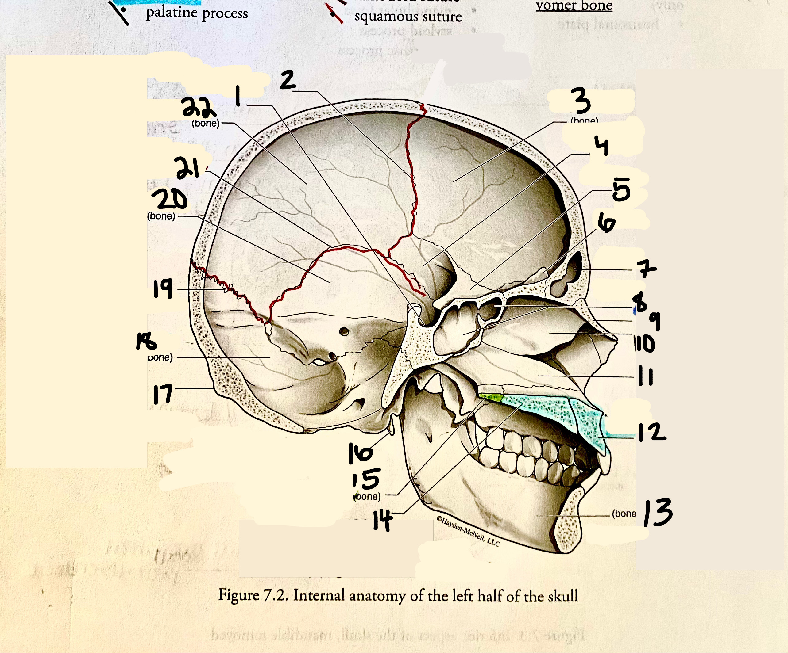 <p>External Occipital Protuberance of the Occipital Bone</p>