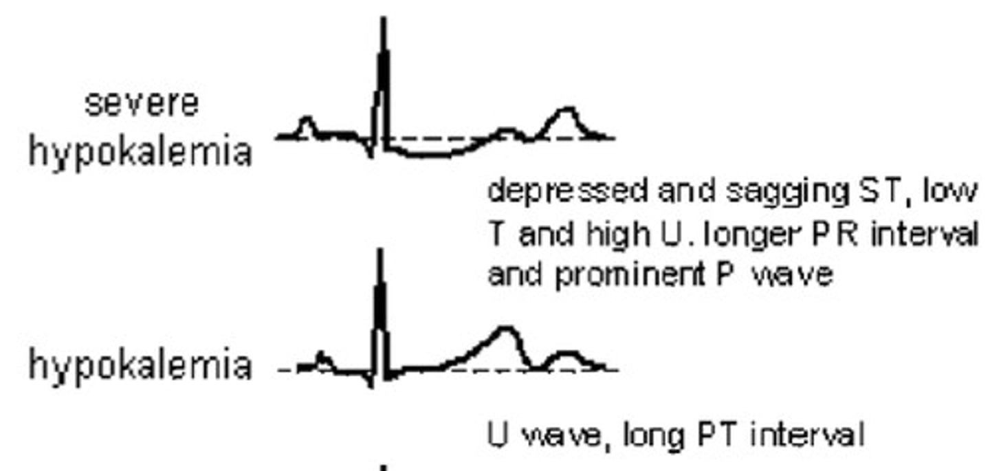 <p>- flat T present</p><p>- depressed ST seg</p><p>- U wave to prominent U wave</p>