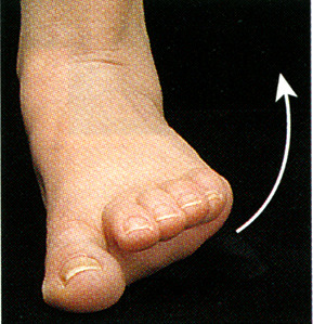 <p>turning the sole of the foot outward</p>