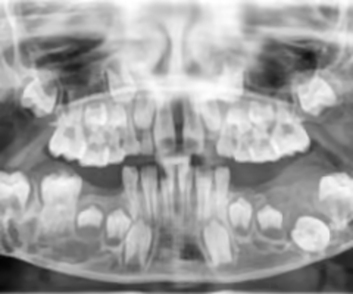 <p>What is the diagnosis?</p><p>6 y/o patient presents to your office with a bilateral chubby face that is firm on palpation. Patient denies pain. Clinically, the mucosa looks normal. Radiograph shows bilateral, multilocular radiolucencies that are multicystic in appearance, in the posterior mandible (some maxilla). There is expansion/thinning of cortices, tooth displacement and resorption of adjacent roots. </p>