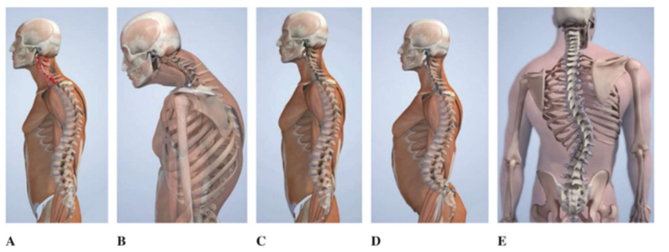 <ul><li><p>Postural faults: (A) </p></li><li><p>Thoracic hyperkyphosis. (B) </p></li><li><p>Forward head. (C) </p></li><li><p>Swayback. (D) </p></li><li><p>Increased lumbar lordosis. (E) Scoliosis.</p></li></ul><p></p>
