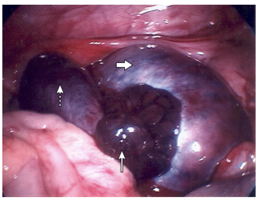 <p>Treatment plan for ovarian torsion</p>