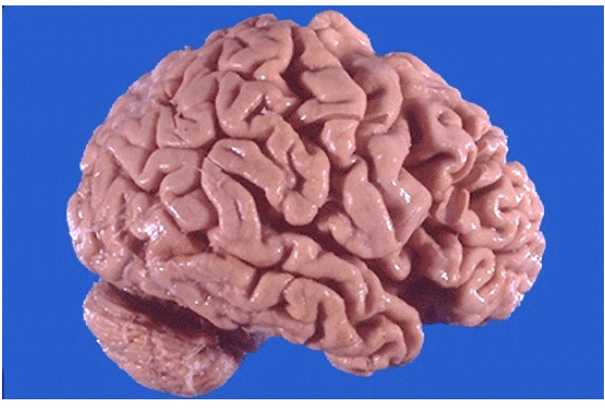 <ol><li><p>Identify the cellular adaptation</p></li><li><p>What is the clinical diagnosis?</p></li></ol><p></p>