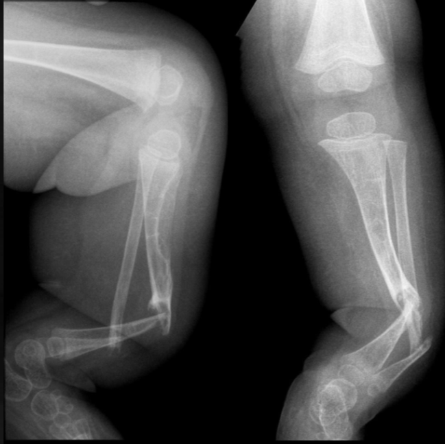 <p>what is seen here for this case of neurofibromatosis type 1?</p>