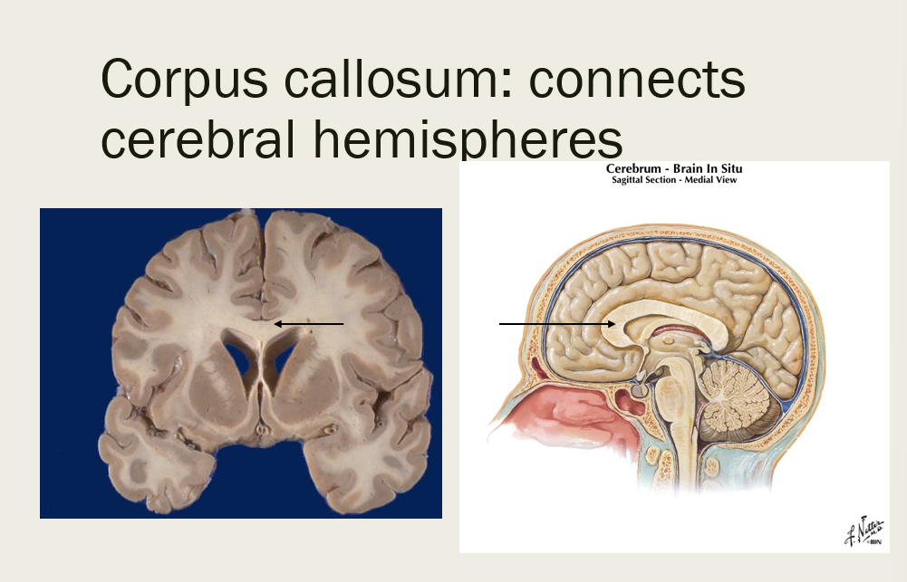 <p>corpus callosum </p>