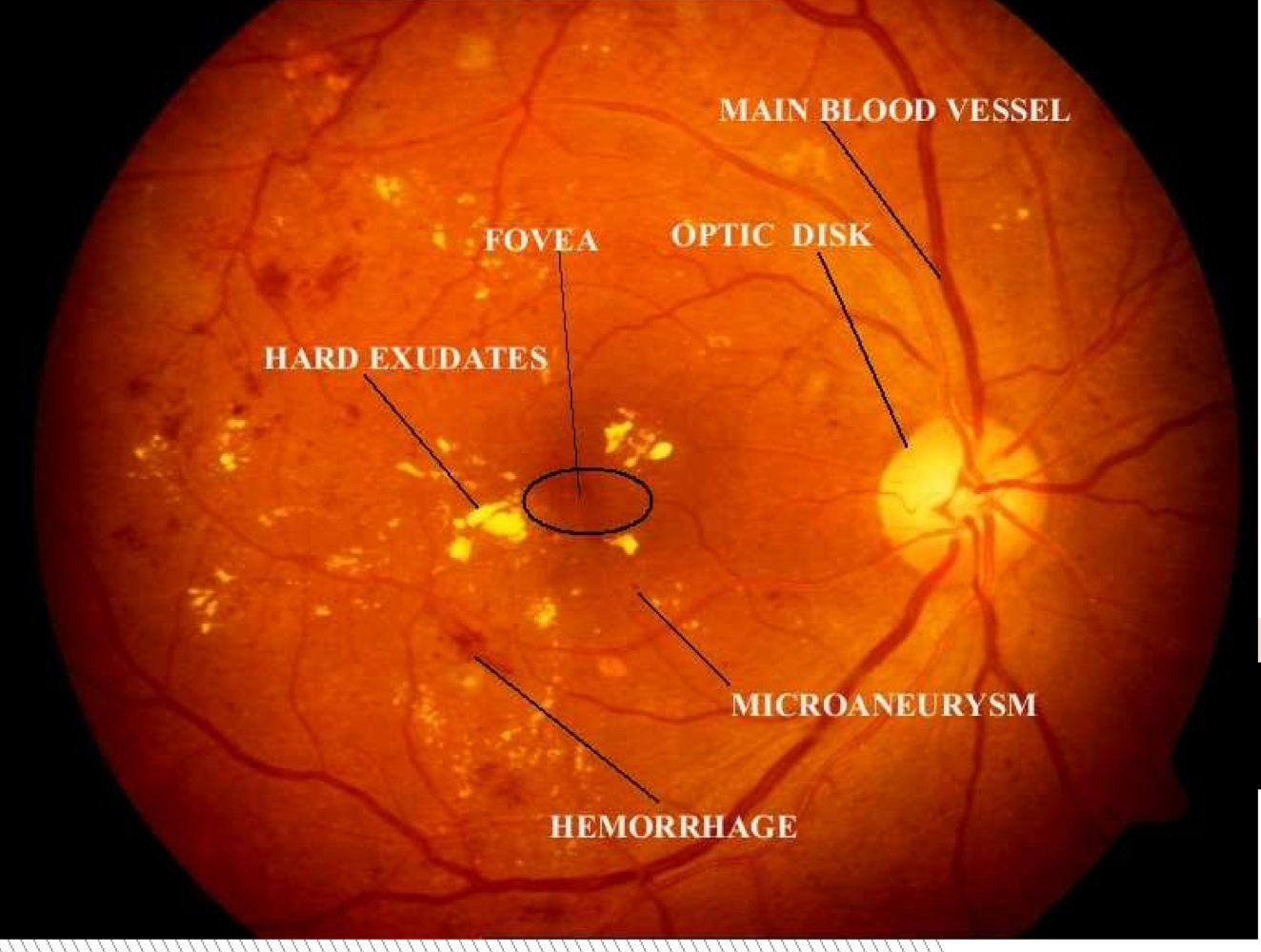 <p>Which type of retinopathy is this?</p>