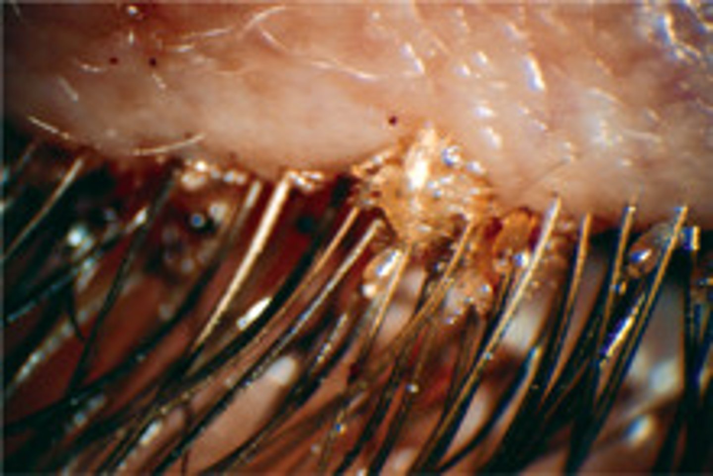<p>Infection of eyelashes caused by Phthirus pubis</p>