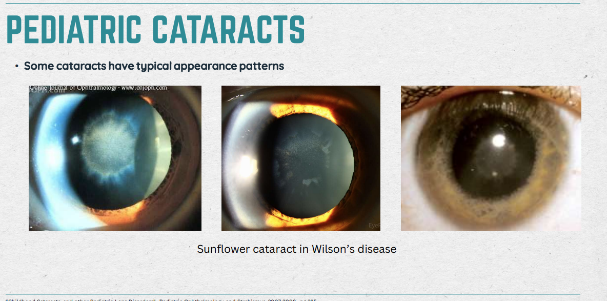 <ul><li><p>resp. for 5-20% of blindness in children worldwide</p></li><li><p>May be: uni/bilateral; isolated or part of systemic condition; congenital or acquired; inherited or sporadic…</p></li><li><p>Causes: Heriditary (autosomal dominant); Trisomy 21 (Downs); Alport syn. Fabry, Wilson disease…</p></li><li><p>Pediatric + OMD</p></li></ul><p></p>