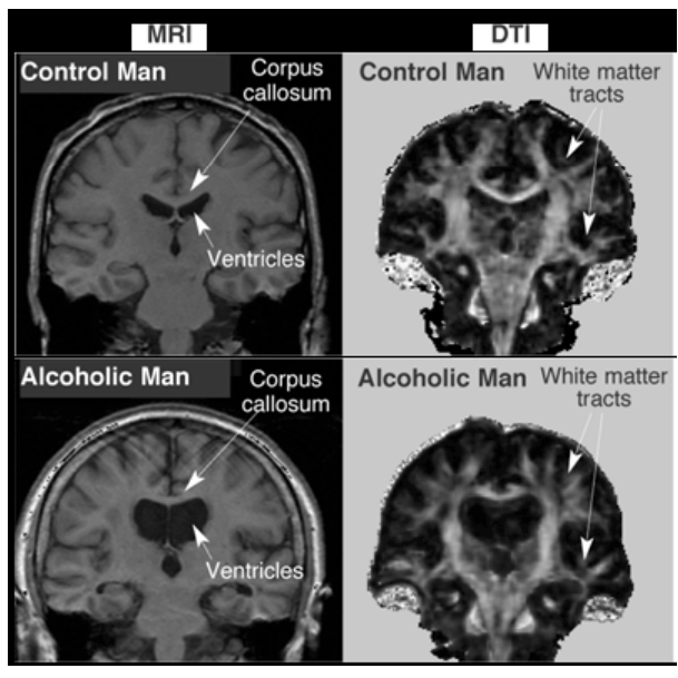 <p>drink shrinks your brain - damages cerebellum and frontal lobe</p><p>note: neurons and glia can recover!!</p>