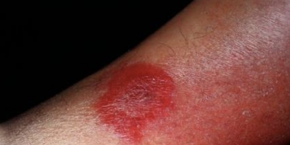 <p><em>Streptococcus pyogenes</em> Infection</p><p>Infection of upper dermis and superficial lymphatics; causes raised, well-demarcated red, swollen, painful area</p><p>Systemic symptoms: fever, chills</p><p></p>