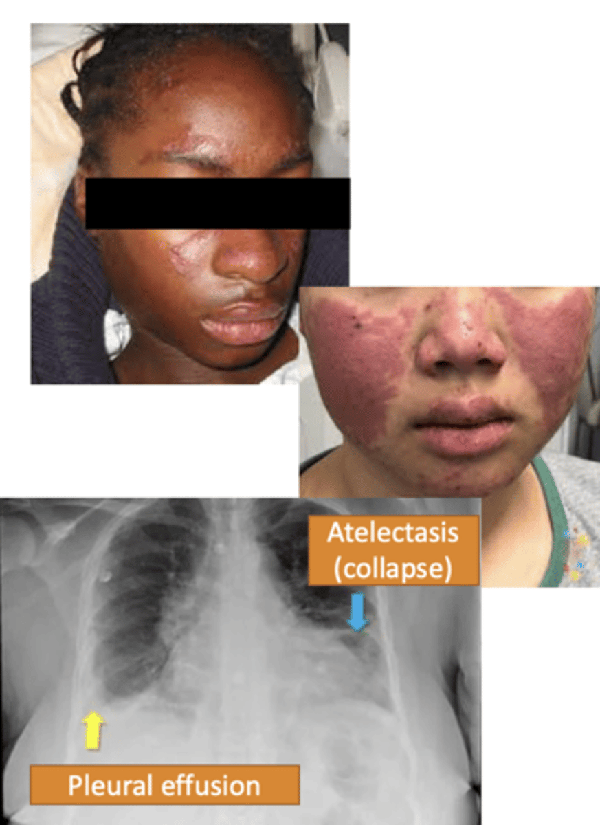 <p>Defective elimination of self-reactive B cells and increase in antibody production, causing tissue damage</p><p>Treatment</p><p>- NSAIDS</p><p>- Antimalarial drugs for lupus rashes or musculoskeletal manifestations</p><p>- High-dose corticosteroids for acute symptoms</p><p>- Monoclonal Antibodies</p><p>-- Block B cell antibody production</p>