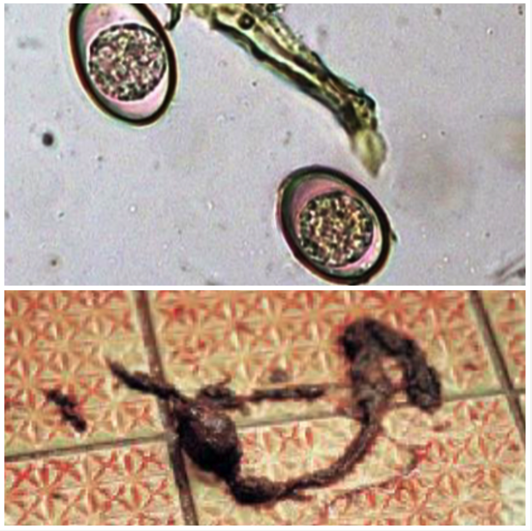 <p>SMALL &amp; LARGE INTESTINE You have 2 month old dairy calves that are anaemic, weak with profuse watery diarrhoea, sometimes with blood, tenesmus and rectal prolapse. The perineum and tail are stained with faeces</p><ul><li><p>Ingestion of sporulated oocysts</p></li><li><p>Need to temp, humidity and vegetation state to sporulate</p></li></ul>