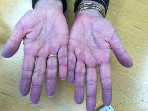 <p><strong>Cyanosis</strong>: Low oxygen levels in the blood </p>