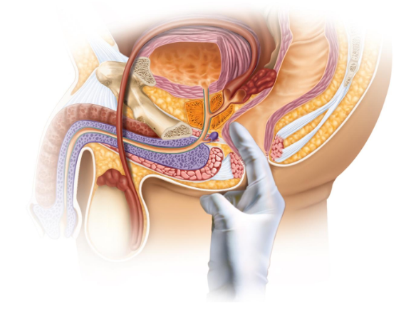 <p><span style="background-color: transparent;"><span>A procedure in which the doctor inserts fingers into the rectum </span></span></p><p><span style="background-color: transparent;"><span>to detect any abnormalities, such as an enlarged prostate</span></span></p>