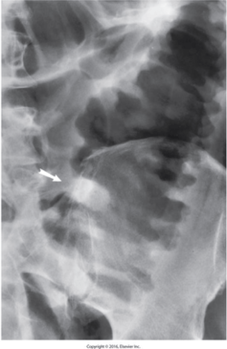 <p>What is Ischemic colitis?</p>
