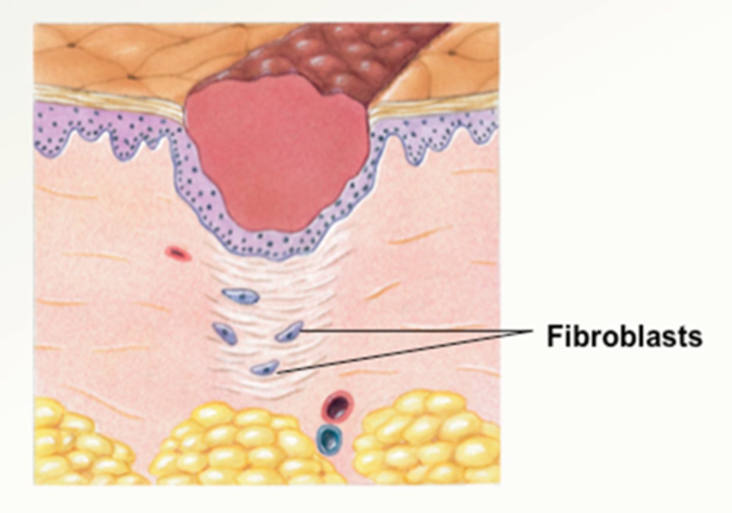 <p>The number and size of fibroblasts increases, causing ground substance and collagen to collect in the traumatized area in preparation to rebuild the damaged tissues</p><p>- revascularization</p><p>- wound contraction</p><p>- wound remodeling</p>