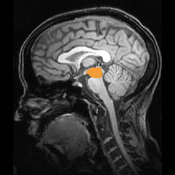 <p>midbrain - roof (tectum, dorsal side), floor (tegmentum, ventral side)</p><ul><li><p>damage = vision/hearing problems, ataxia, lack of pain inhibition, tremors, motor deficits</p></li></ul><p></p>