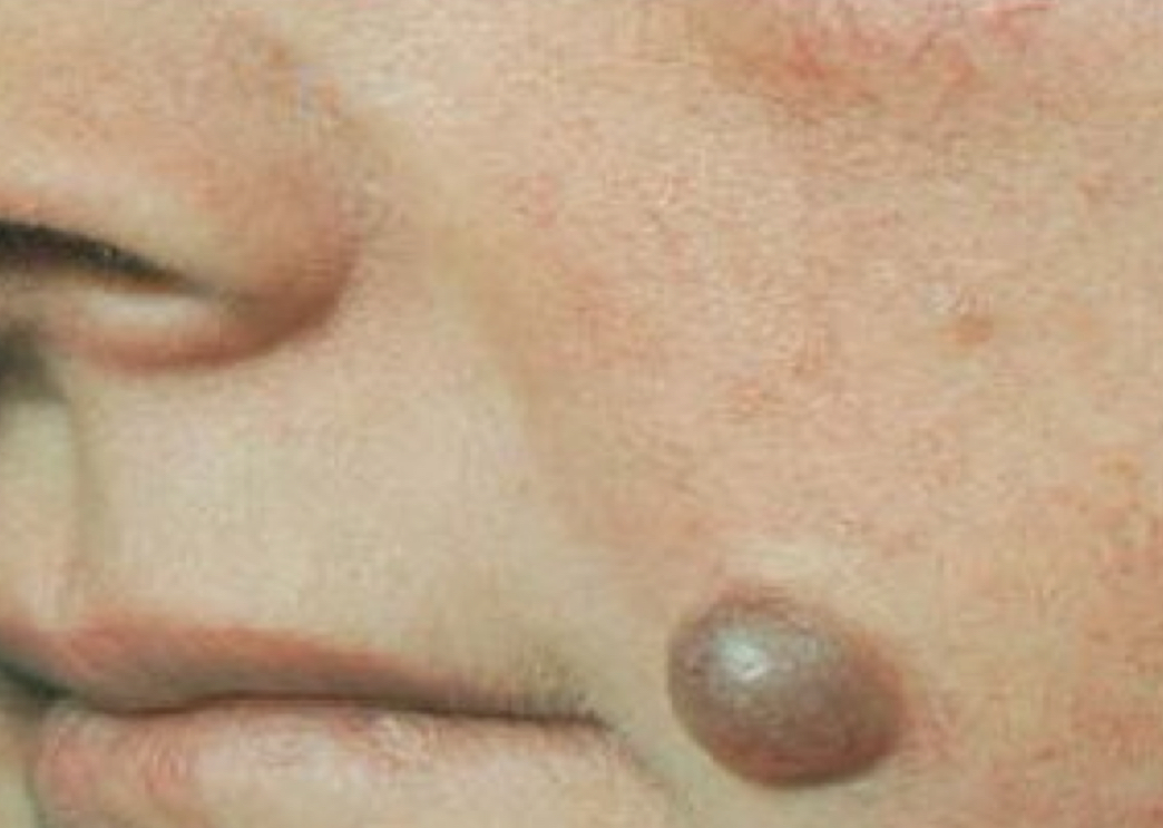 <p>what lesion is depicted</p>