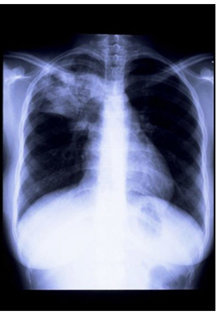 <p>A 17-year-old adolescent girl presents with dyspnea. It is persistent and chronic for 3 months. She also elicits productive, cough, fever, and night sweats of a persistent, chronic nature; chronic bright red hemoptysis; pleuritic chest pain; and loss of appetite. On physical examination, chest crackles are appreciated in the right upper lobe, accentuated after a short cough. Chest radiography is performed as shown. Of the following, what is the most likely location for an anterior Chapman point in this patient?</p>