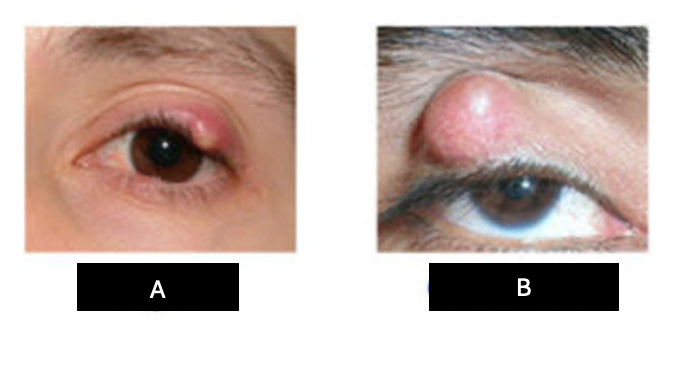<p>In the image presented, which is chalazion and hordeolum</p>