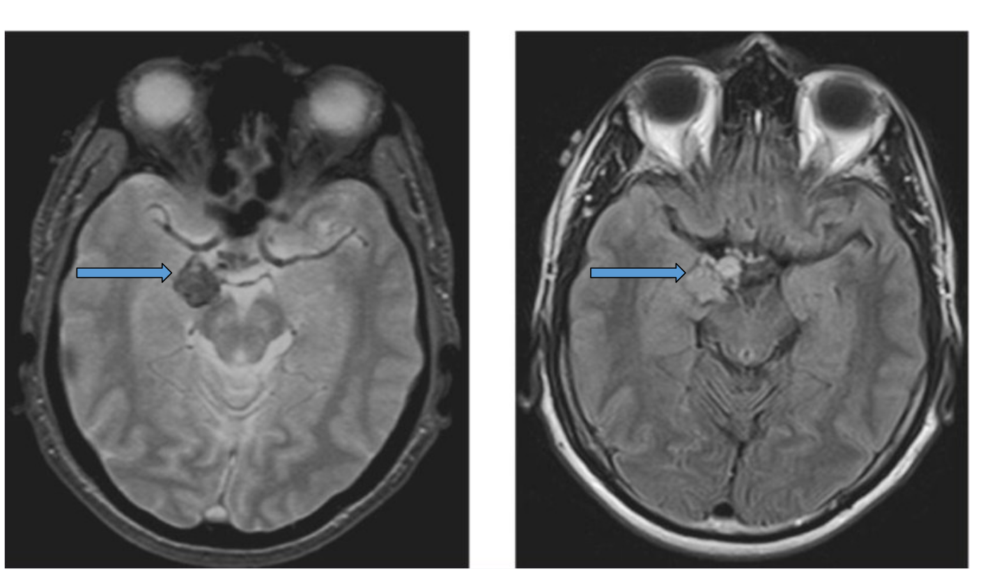 <p>patients presents with difficulty findings words, hyper sexual behavior, flirtatious, patient most likely has damage to her _____ and ___ _____ syndrome, damage could be bilateral or unilateral  </p>