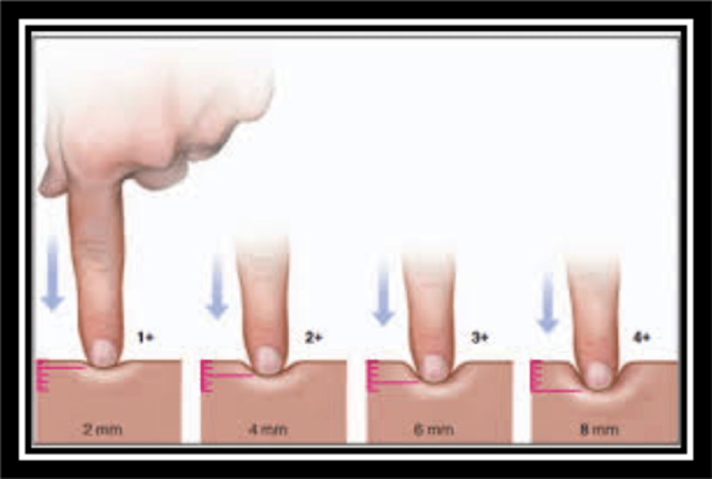<p>instructions:</p><p>Instruct the patient that you're performing an assessment to see if they have pitting edema by applying pressure to the swollen area to see if there is an indentation. The patient can be sitting or standing while the test is being performed.</p><p>procedure:</p><p>I will press into the swollen area, and an indentation will remain after my fingers are lifted when pitting edema is present.</p><p>There is a pitting edema scale:</p><p>1+ is a barely perceptible pit (2 mm)</p><p>2+ is a deeper pit, rebounds in a few seconds (4 mm)</p><p>3+ is a deep pit, rebounds in 10-20 seconds (6 mm)</p><p>4+ is a deeper pit, rebounds in >30 seconds (8 mm)</p>