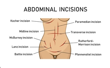 <p class="">A midline incision along the <strong>linea alba</strong> </p><p class="">used in abdominal surgeries, </p><p class="">like exploratory surgeries or removing organs</p><ul><li><p class=""><strong>Pfannenstiel Incision</strong>: Transverse incision below the umbilicus (commonly used for <strong>C-sections</strong>).</p></li><li><p class=""><strong>McBurney Incision</strong>: Oblique incision in the lower right quadrant (used in <strong>appendectomy</strong>).</p></li><li><p class=""><strong>Kocher Incision</strong>: Subcostal incision, used for gall bladder surgery or biliary tree pathologies.</p></li></ul><p></p>