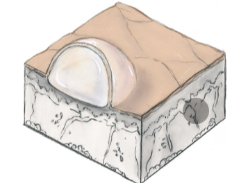 Vesicle 